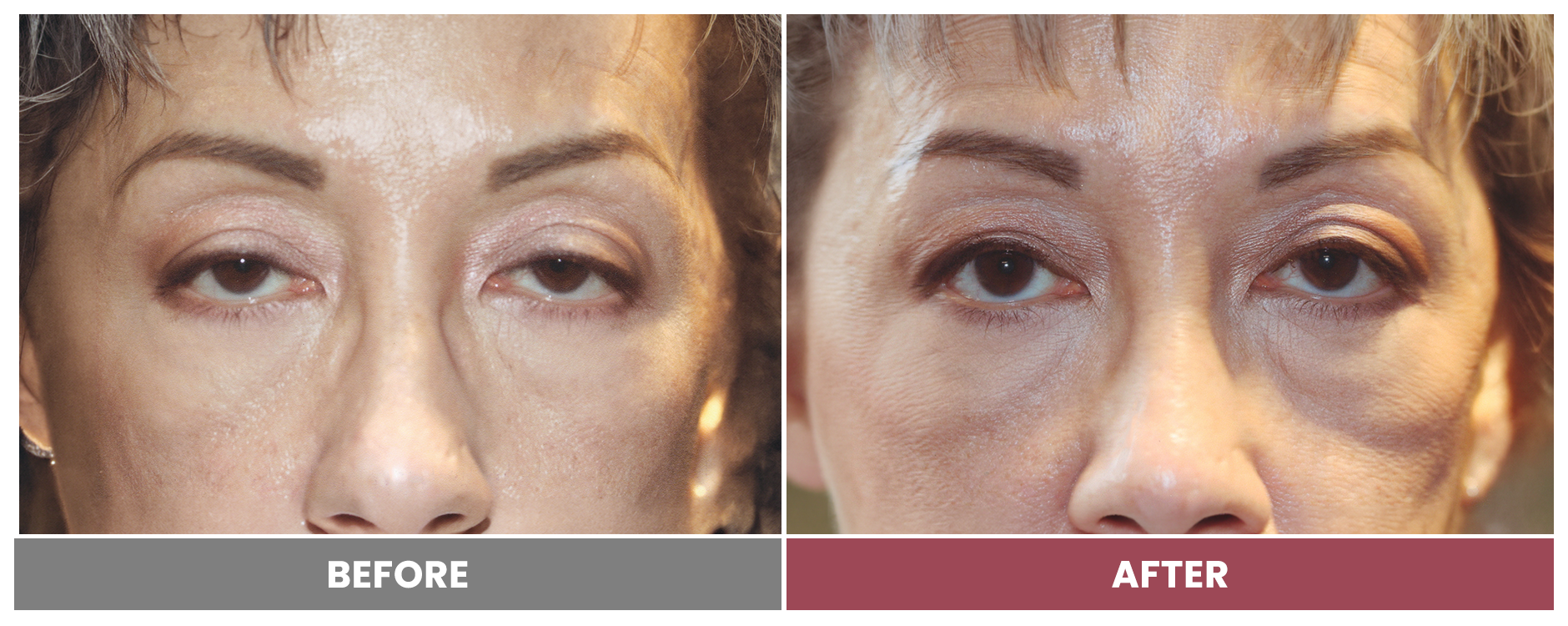 PTOSIS REPAIR - Case 47